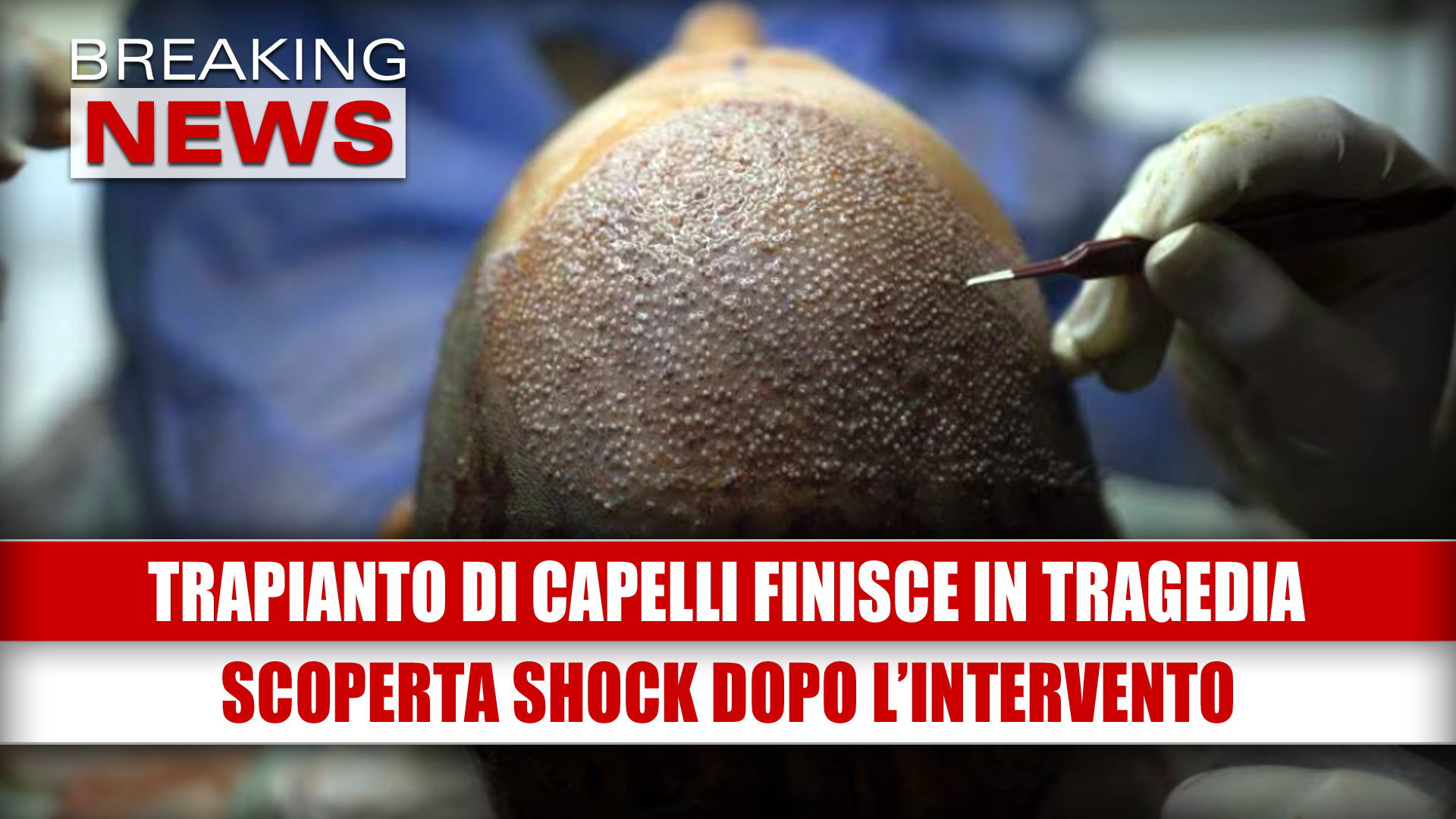 TRAPIANTO DI CAPELLI FINISCE IN TRAGEDIA: la scoperta shock dopo l'intervento!